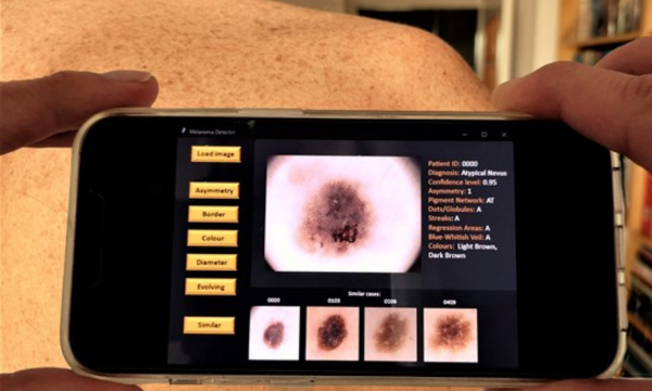 USW Researchers Working On App That Could Help GPs Spot Potential Skin Problems